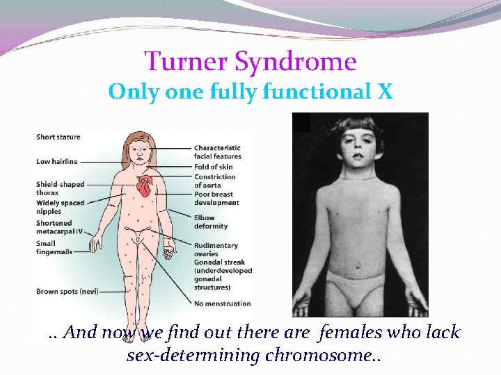 Turner Syndrome Only one fully functional X . . And now we find out Turner Syndrome Only one fully functional X . . And now we find out