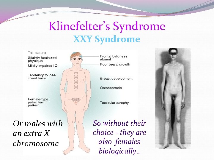Klinefelter’s Syndrome XXY Syndrome Or males with an extra X chromosome So without their Klinefelter’s Syndrome XXY Syndrome Or males with an extra X chromosome So without their