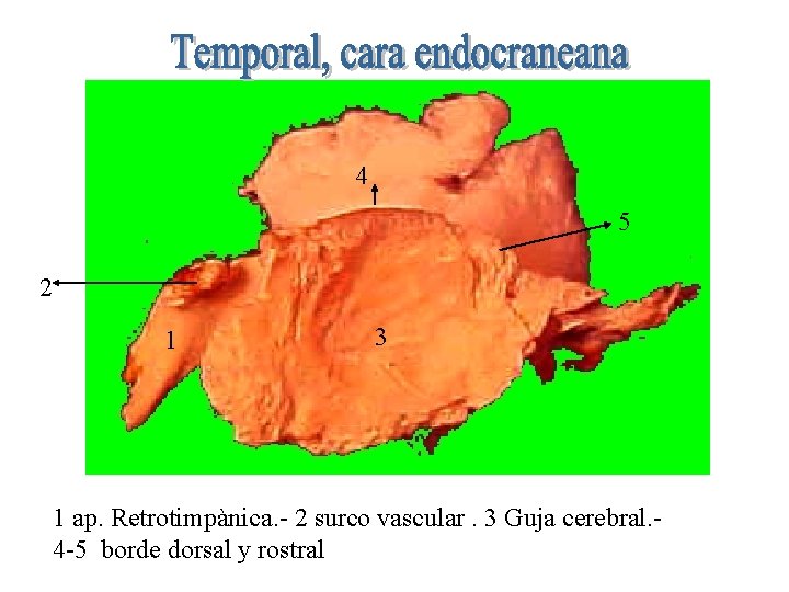 4 5 2 1 3 1 ap. Retrotimpànica. - 2 surco vascular. 3 Guja