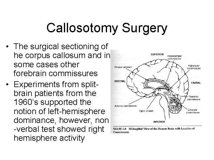 Callosotomy Surgery • The surgical sectioning of he corpus callosum and in some cases
