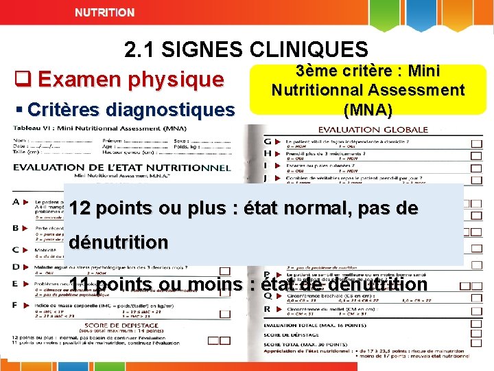 2. 1 SIGNES CLINIQUES 3ème critère : Mini q Examen physique Nutritionnal Assessment §