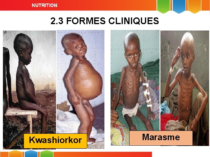 2. 3 FORMES CLINIQUES Kwashiorkor Marasme 