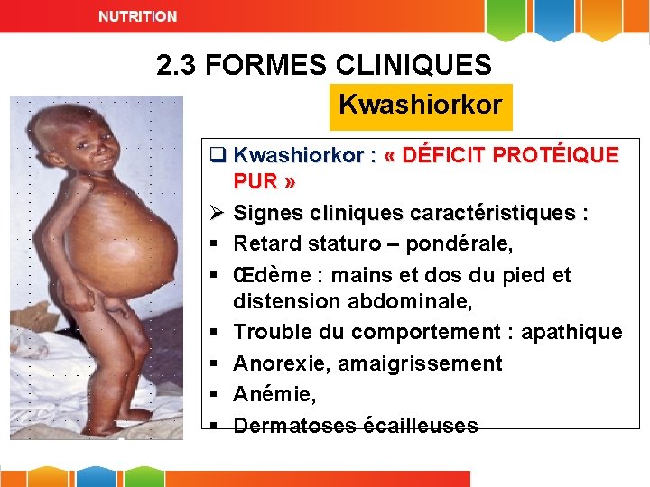 2. 3 FORMES CLINIQUES Kwashiorkor q Kwashiorkor : « DÉFICIT PROTÉIQUE PUR » Ø