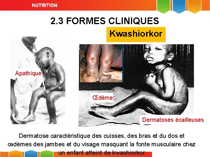 2. 3 FORMES CLINIQUES Kwashiorkor Apathique Œdème: Dermatoses écailleuses Dermatose caractéristique des cuisses, des