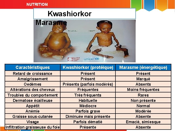 Kwashiorkor Marasme Caractéristiques Kwashiorkor (protéique) Retard de croissance Présent Amaigrissement Présent Oedèmes Présents (parfois