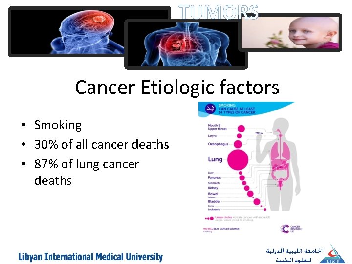 TUMORS Cancer Etiologic factors • Smoking • 30% of all cancer deaths • 87%