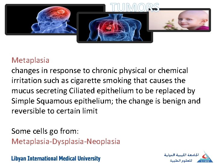 TUMORS Metaplasia changes in response to chronic physical or chemical irritation such as cigarette