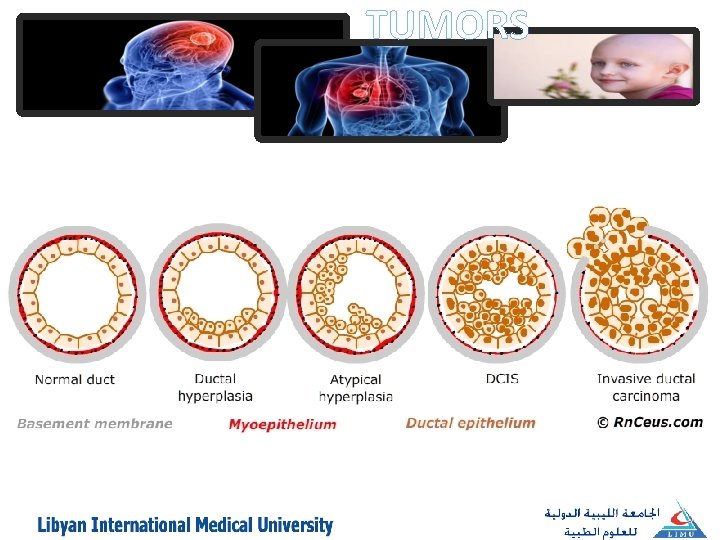 TUMORS 