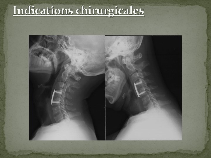 Indications chirurgicales 