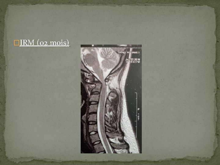 �IRM (02 mois) 