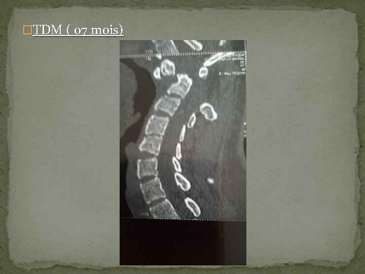�TDM ( 07 mois) 