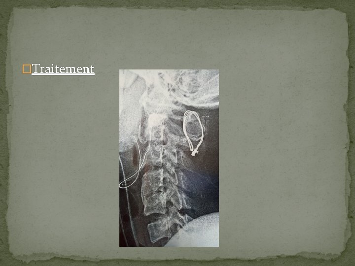 �Traitement 