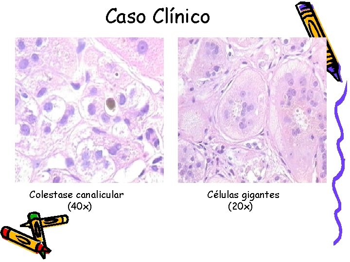 Caso Clínico Colestase canalicular (40 x) Células gigantes (20 x) 