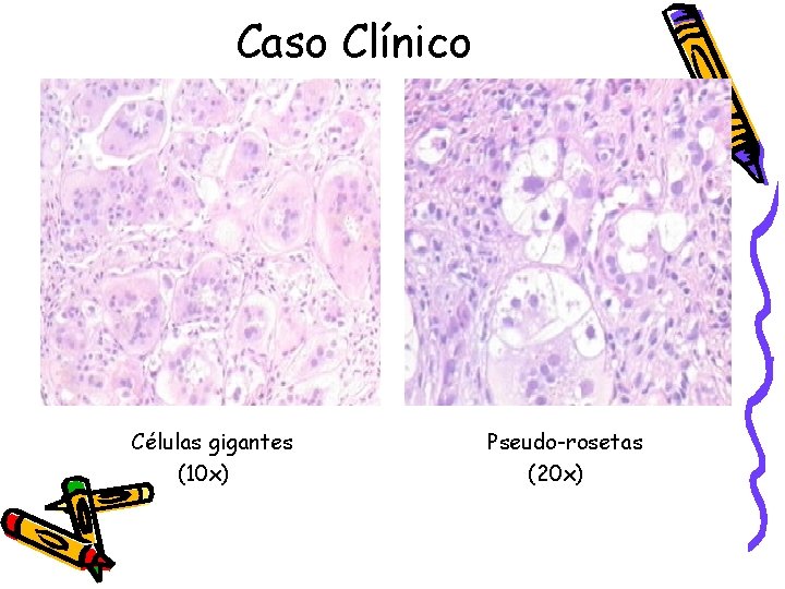 Caso Clínico Células gigantes (10 x) Pseudo-rosetas (20 x) 