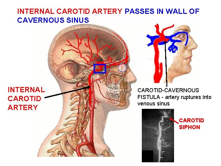 INTERNAL CAROTID ARTERY PASSES IN WALL OF CAVERNOUS SINUS INTERNAL CAROTID ARTERY CAROTID-CAVERNOUS FISTULA