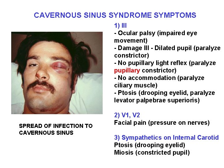 CAVERNOUS SINUS SYNDROME SYMPTOMS 1) III - Ocular palsy (impaired eye movement) - Damage