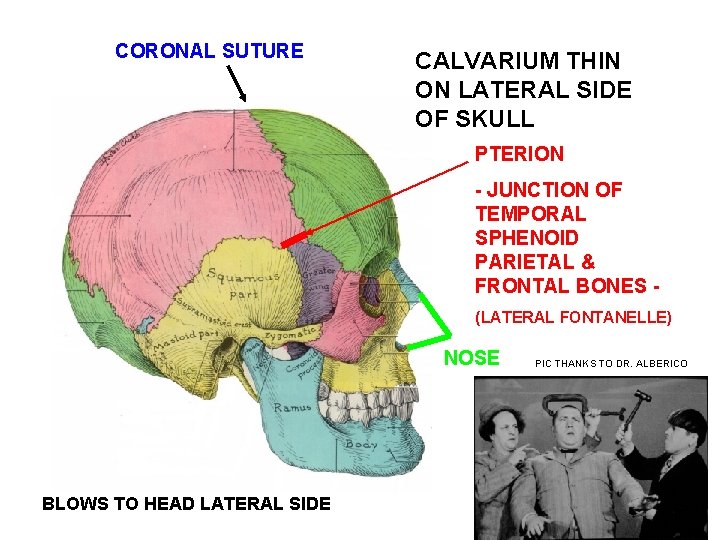 CORONAL SUTURE CALVARIUM THIN ON LATERAL SIDE OF SKULL PTERION - JUNCTION OF TEMPORAL