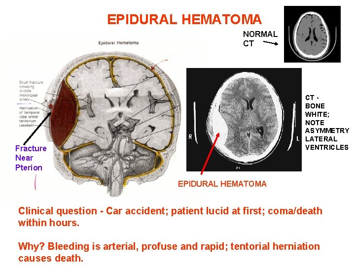 EPIDURAL HEMATOMA NORMAL CT CT BONE WHITE; NOTE ASYMMETRY LATERAL VENTRICLES Fracture Near Pterion