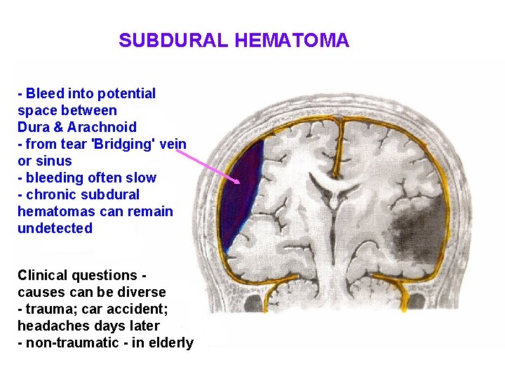 SUBDURAL HEMATOMA - Bleed into potential space between Dura & Arachnoid - from tear