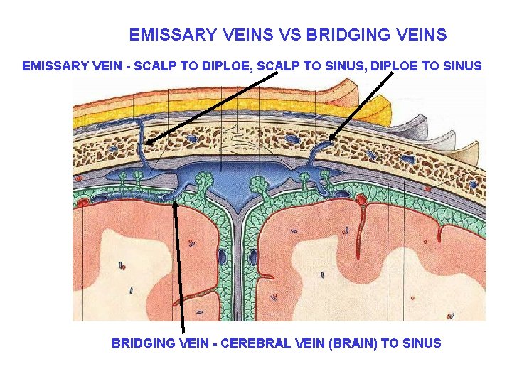 EMISSARY VEINS VS BRIDGING VEINS EMISSARY VEIN - SCALP TO DIPLOE, SCALP TO SINUS,