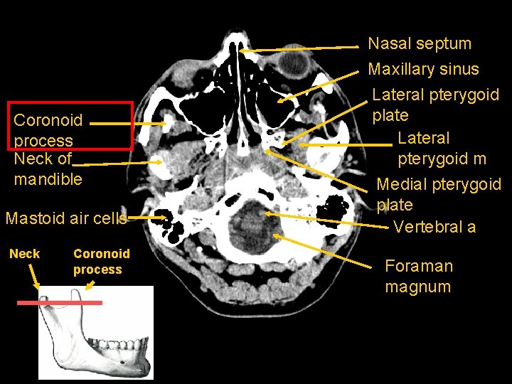 Coronoid process Neck of mandible Mastoid air cells Neck Coronoid process Nasal septum Maxillary