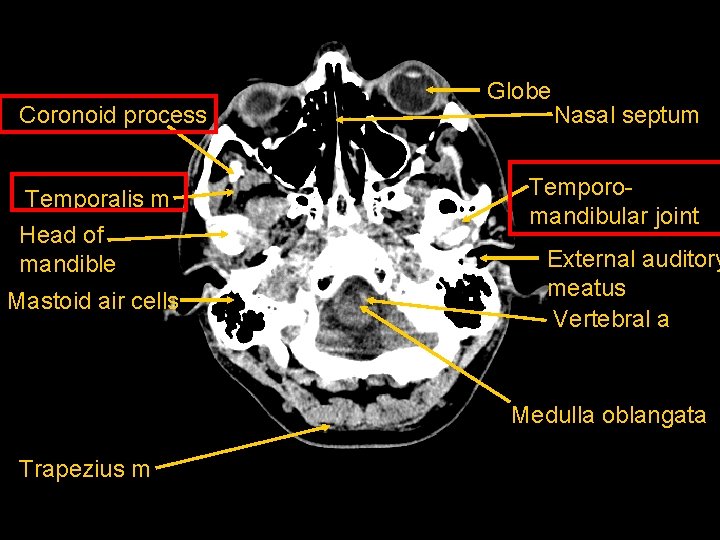 Coronoid process Temporalis m Head of mandible Mastoid air cells Globe Nasal septum Temporomandibular