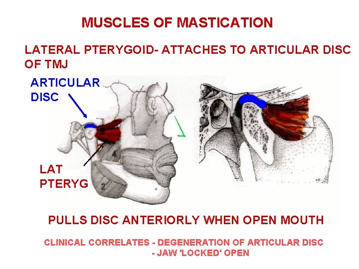 MUSCLES OF MASTICATION LATERAL PTERYGOID- ATTACHES TO ARTICULAR DISC OF TMJ ARTICULAR DISC LAT