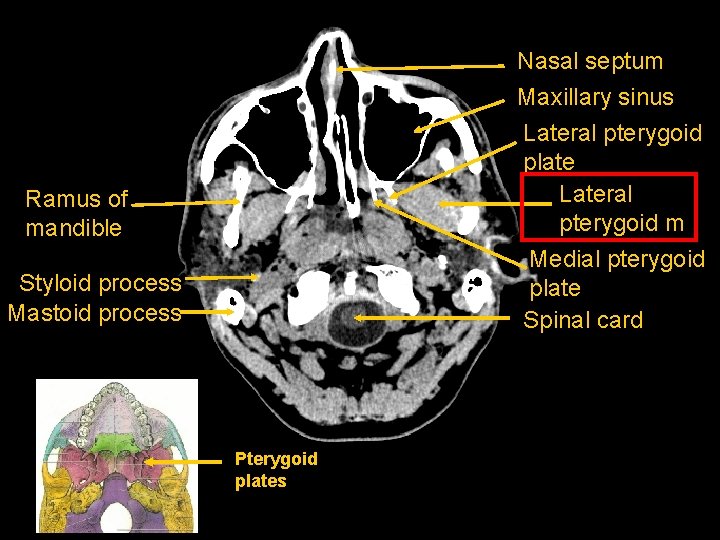 Nasal septum Maxillary sinus Lateral pterygoid plate Lateral pterygoid m Medial pterygoid plate Spinal