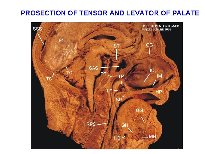 PROSECTION OF TENSOR AND LEVATOR OF PALATE 