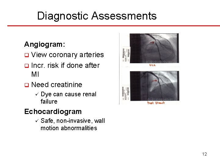 Diagnostic Assessments Angiogram: q View coronary arteries q Incr. risk if done after MI