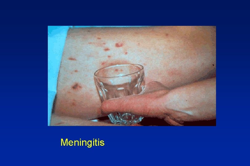 Meningitis 