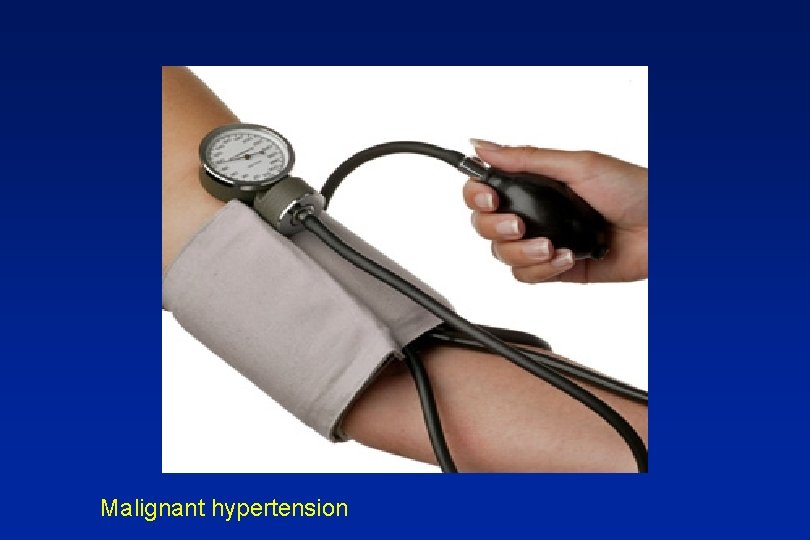 Malignant hypertension 