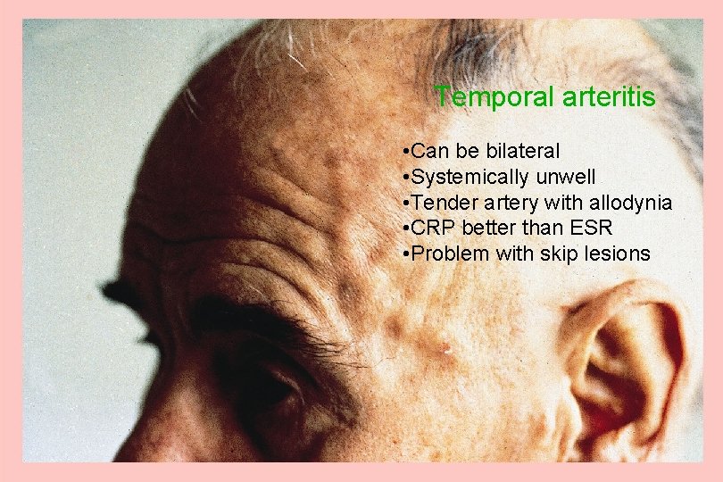 Temporal arteritis • Can be bilateral • Systemically unwell • Tender artery with allodynia