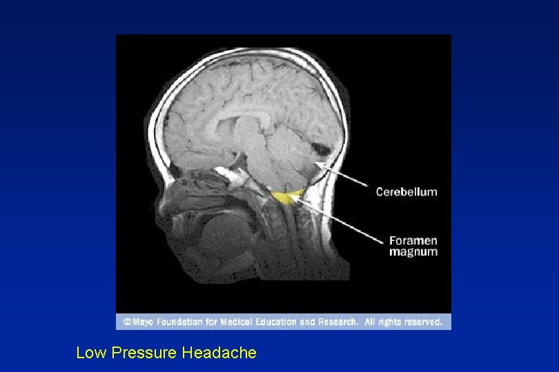 Low Pressure Headache 