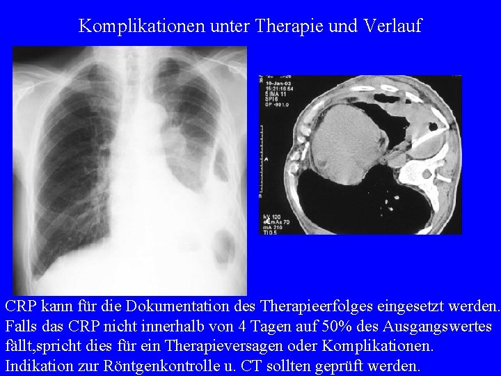 metastatic mesothelioma to brain