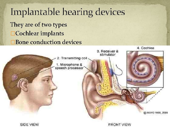 Implantable hearing devices They are of two types �Cochlear implants �Bone conduction devices 