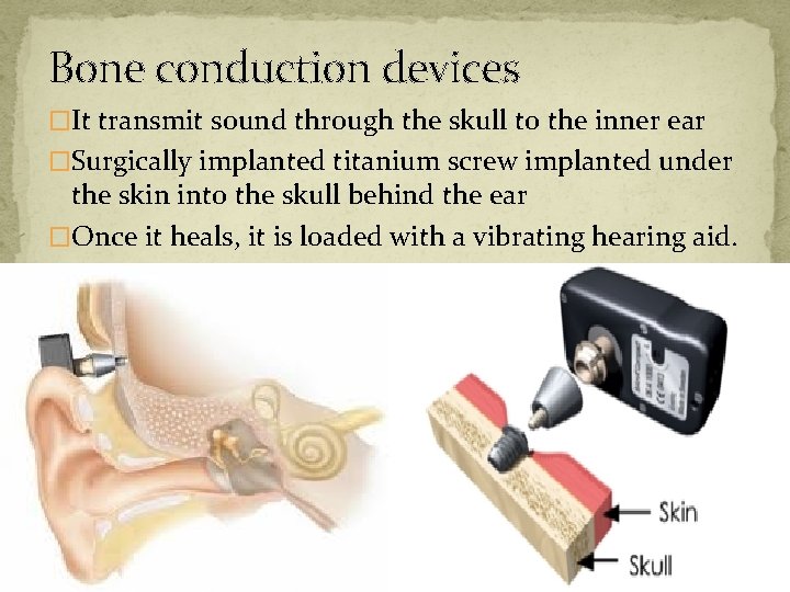 Bone conduction devices �It transmit sound through the skull to the inner ear �Surgically