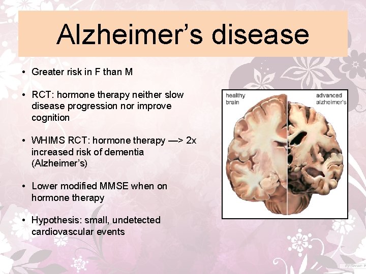 Alzheimer’s disease • Greater risk in F than M • RCT: hormone therapy neither