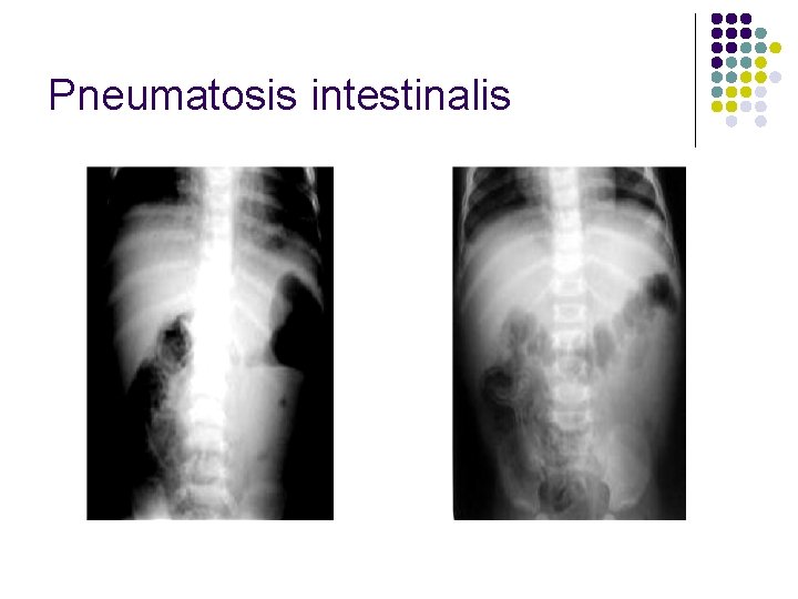Pneumatosis intestinalis 
