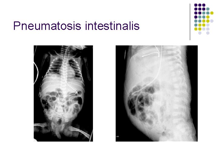 Pneumatosis intestinalis 