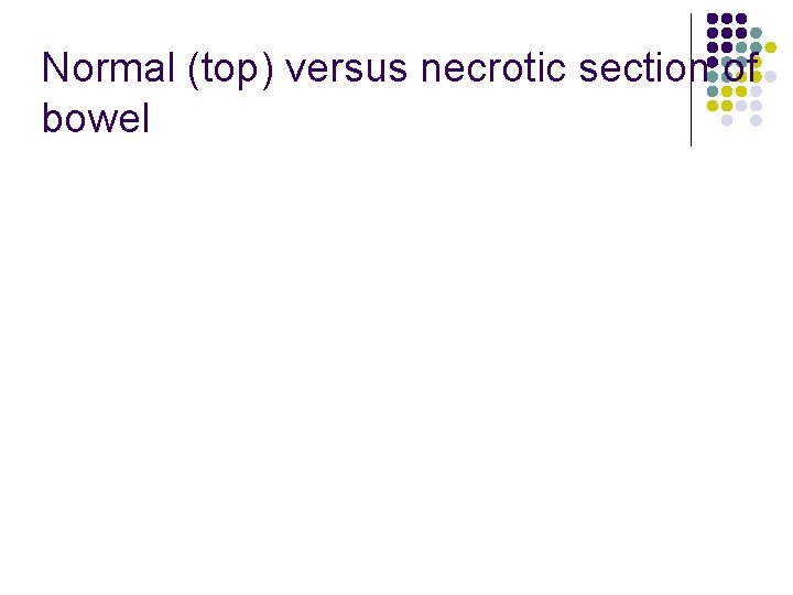 Normal (top) versus necrotic section of bowel 