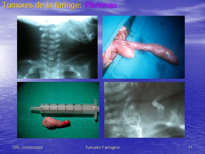 Tumores de la faringe: Fibromas ORL Universidad Tumores Faríngeos 11 