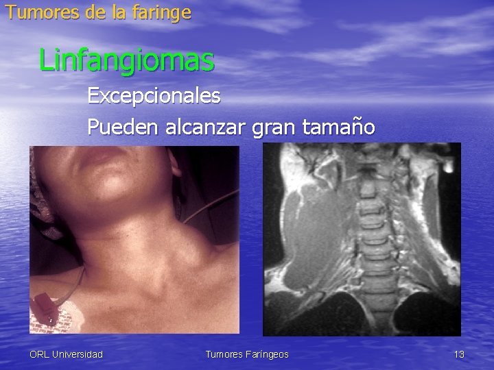 Tumores de la faringe Linfangiomas Excepcionales Pueden alcanzar gran tamaño ORL Universidad Tumores Faríngeos