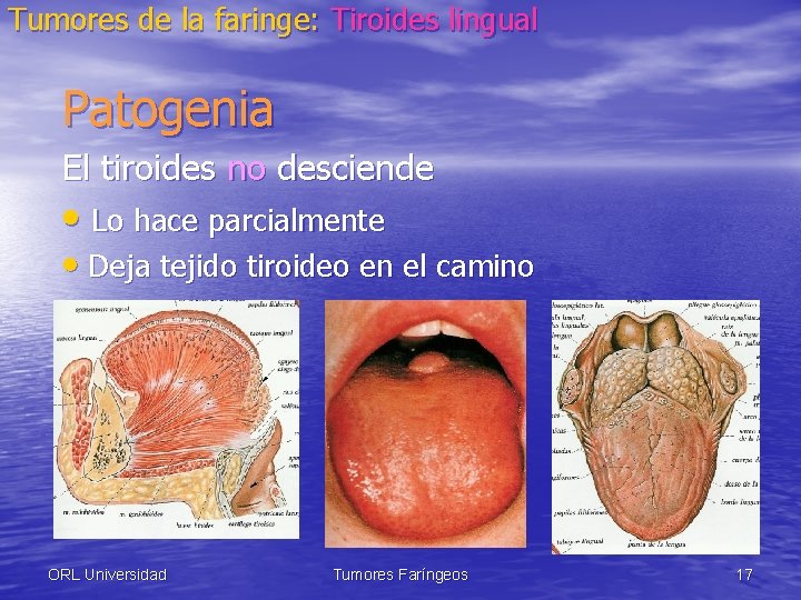 Tumores de la faringe: Tiroides lingual Patogenia El tiroides no desciende • Lo hace
