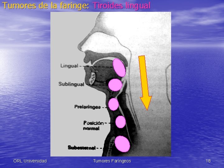 Tumores de la faringe: Tiroides lingual ORL Universidad Tumores Faríngeos 18 