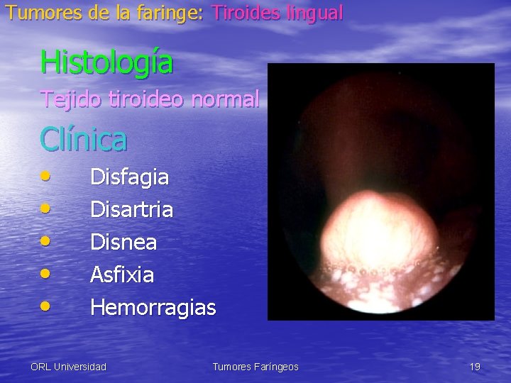 Tumores de la faringe: Tiroides lingual Histología Tejido tiroideo normal Clínica • • •