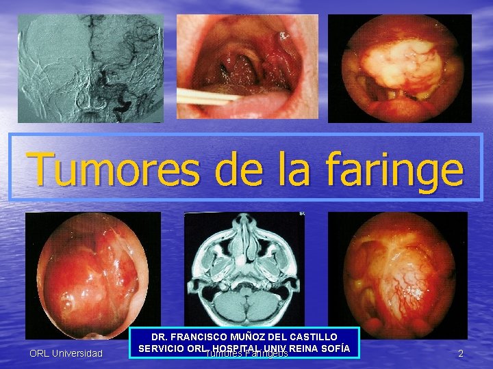 Tumores de la faringe ORL Universidad DR. FRANCISCO MUÑOZ DEL CASTILLO SERVICIO ORL. HOSPITAL