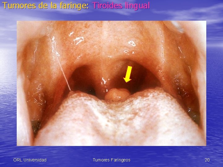 Tumores de la faringe: Tiroides lingual ORL Universidad Tumores Faríngeos 20 