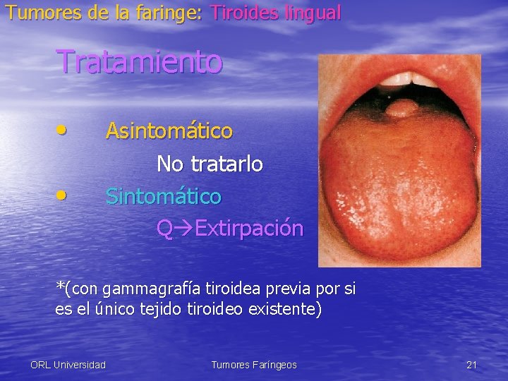 Tumores de la faringe: Tiroides lingual Tratamiento • • Asintomático No tratarlo Sintomático Q