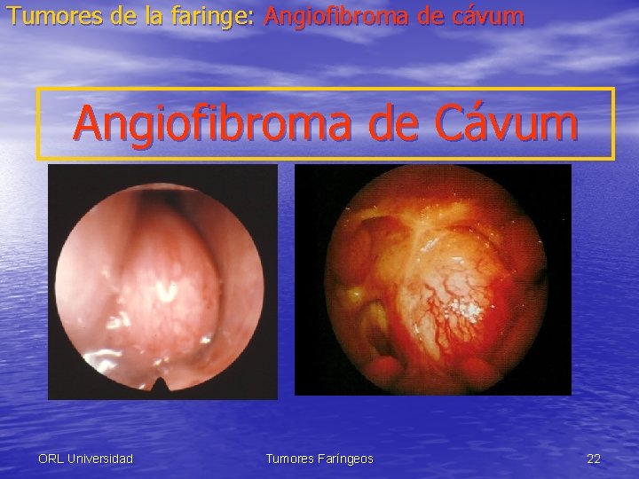 Tumores de la faringe: Angiofibroma de cávum Angiofibroma de Cávum ORL Universidad Tumores Faríngeos